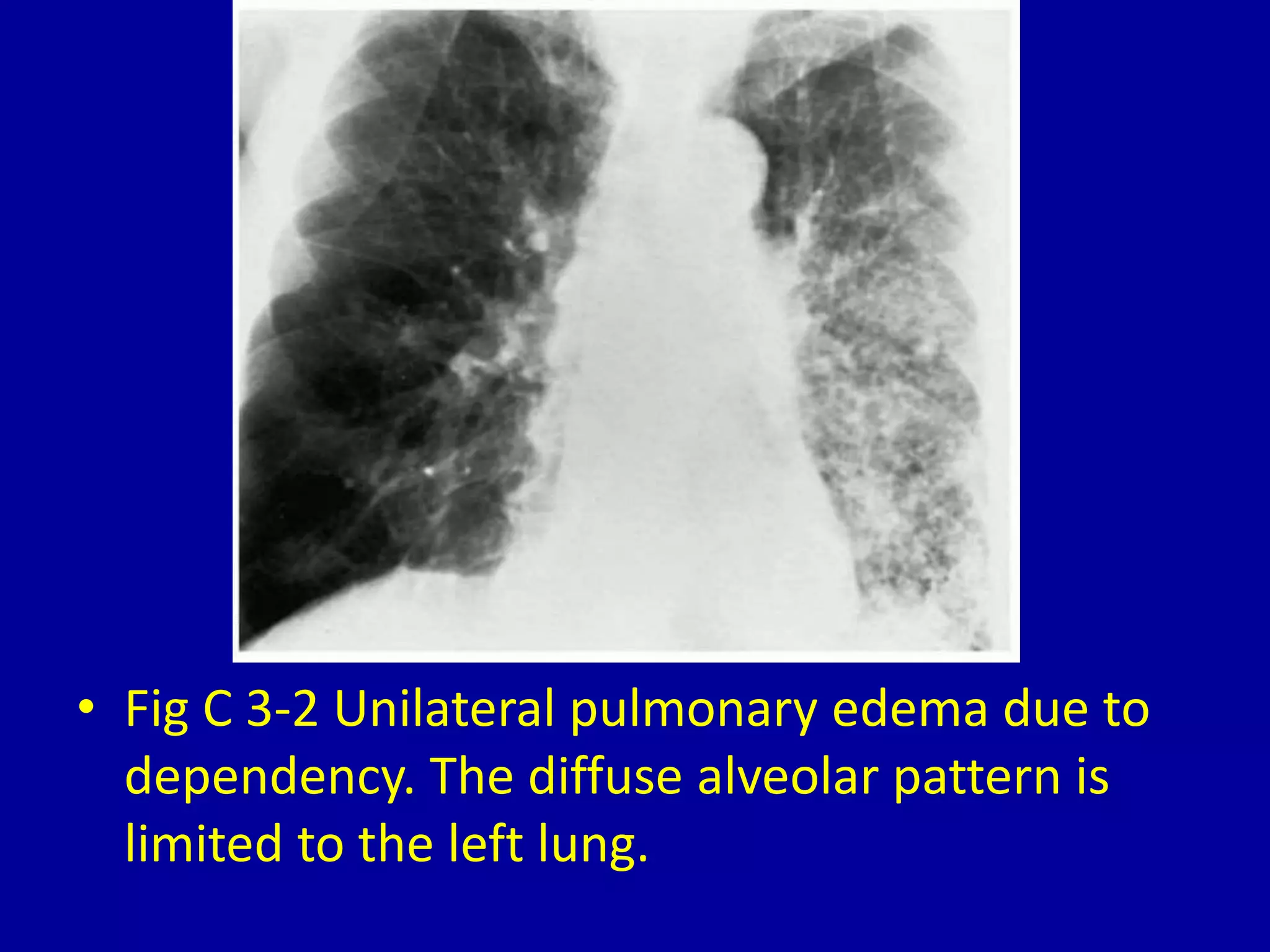 • Fig C 3-2 Unilateral pulmonary edema due to
dependency. The diffuse alveolar pattern is
limited to the left lung.