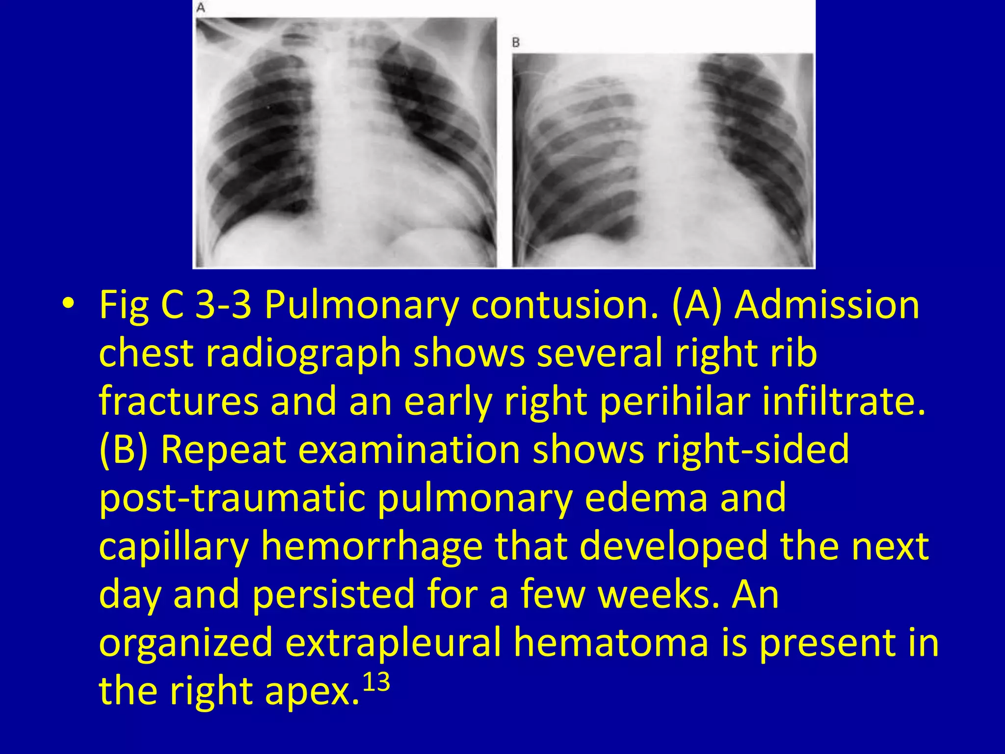 • Fig C 3-3 Pulmonary contusion. (A) Admission
chest radiograph shows several right rib
fractures and an early right perihilar infiltrate.
(B) Repeat examination shows right-sided
post-traumatic pulmonary edema and
capillary hemorrhage that developed the next
day and persisted for a few weeks. An
organized extrapleural hematoma is present in
the right apex.13