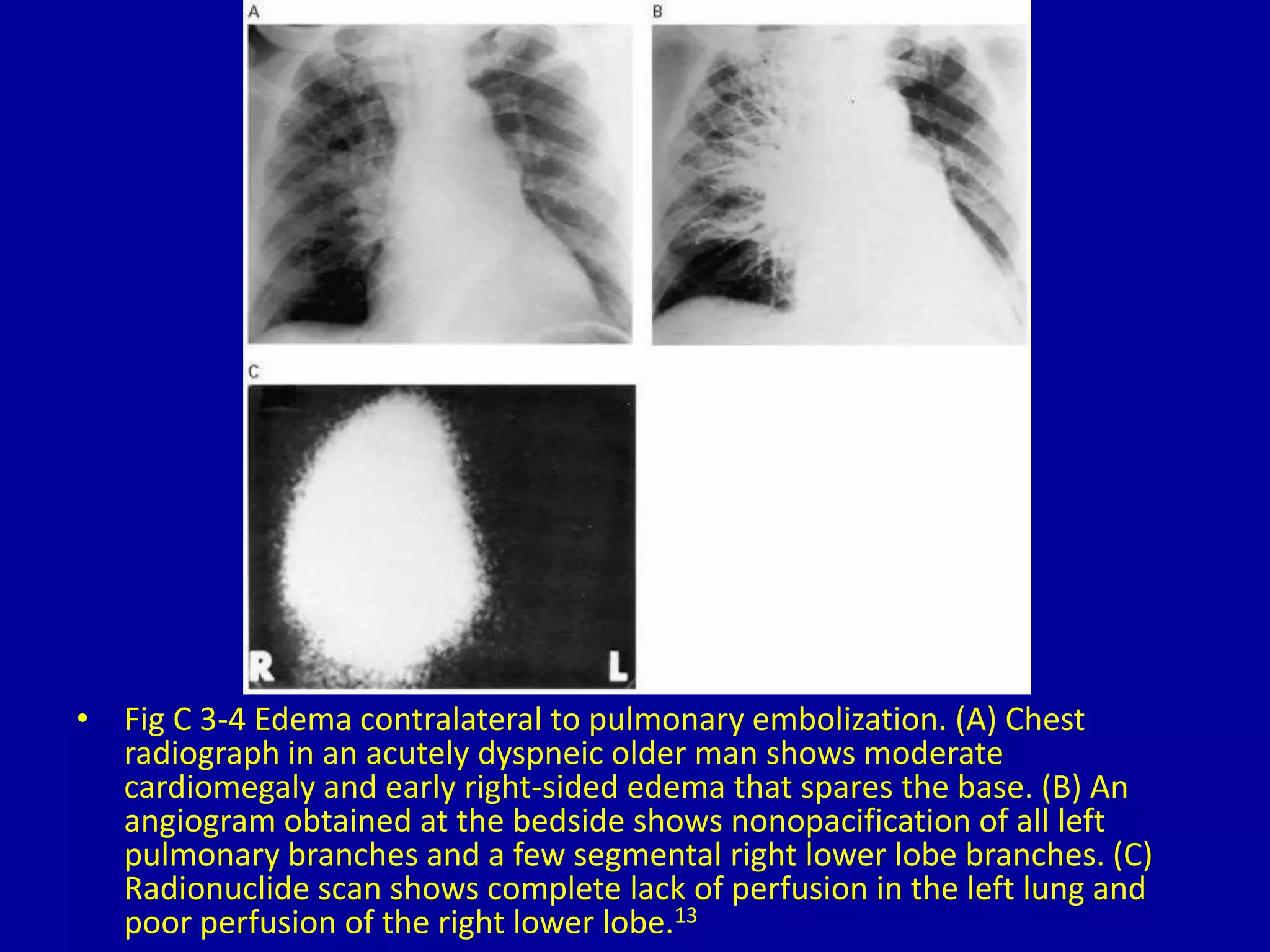 • Fig C 3-4 Edema contralateral to pulmonary embolization. (A) Chest
radiograph in an acutely dyspneic older man shows moderate
cardiomegaly and early right-sided edema that spares the base. (B) An
angiogram obtained at the bedside shows nonopacification of all left
pulmonary branches and a few segmental right lower lobe branches. (C)
Radionuclide scan shows complete lack of perfusion in the left lung and
poor perfusion of the right lower lobe.13