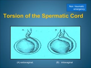 Torsion of the Spermatic Cord
(A) extravaginal; (B) intravaginal
Non traumatic
emergency
 