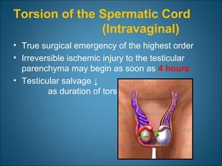 Torsion of the Spermatic Cord
(Intravaginal)
• True surgical emergency of the highest order
• Irreversible ischemic injury to the testicular
parenchyma may begin as soon as 4 hours
• Testicular salvage ↓
as duration of torsion↑
 