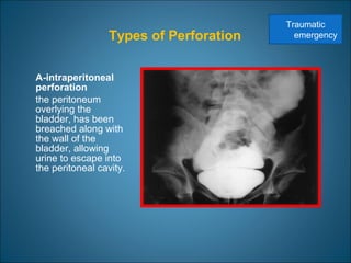 Types of Perforation
A-intraperitoneal
perforation
the peritoneum
overlying the
bladder, has been
breached along with
the wall of the
bladder, allowing
urine to escape into
the peritoneal cavity.
Traumatic
emergency
 