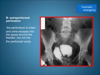 B- extraperitoneal
perforation
the peritoneum is intact
and urine escapes into
the space around the
bladder, but not into
the peritoneal cavity.
Traumatic
emergency
 