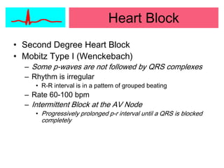 Mobitz Patterns Perioperative%20%20%20%20%20%20%20%20 arrhythmias | PPTX