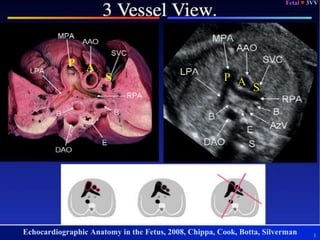 Fetal ♥ EchoFetal ♥ Echo
1
Fetal ♥ 3VV
Echocardiographic Anatomy in the Fetus, 2008, Chippa, Cook, Botta, Silverman
P A S
S
AP
 