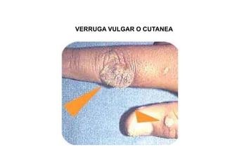 VERRUGA VULGAR O CUTANEA

 