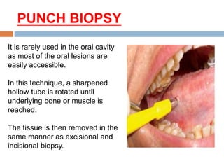PUNCH BIOPSY
It is rarely used in the oral cavity
as most of the oral lesions are
easily accessible.
In this technique, a sharpened
hollow tube is rotated until
underlying bone or muscle is
reached.
The tissue is then removed in the
same manner as excisional and
incisional biopsy.
 
