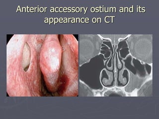 Accessory Ostium endoscopic_ana_of_nose__PNS in otolaryngology .ppt