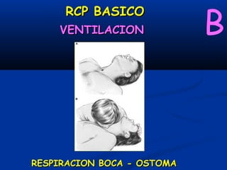 B
     RCP BASICO
    VENTILACION




RESPIRACION BOCA - OSTOMA
 