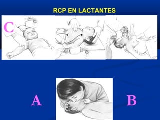 RCP EN LACTANTES


C



    A                      B
 