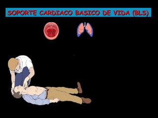 SOPORTE CARDIACO BASICO DE VIDA (BLS)
 