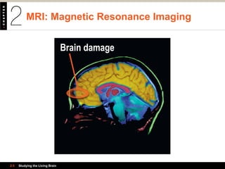 MRI: Magnetic Resonance Imaging
2.5 Studying the Living Brain
Brain damage
 