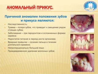 БруксизмБруксизм означает скрежетание зубами. Скрежетание – это непроизвольное сжимание челюстей и воспроизведение зубами определенных звуков.          Обычно это явление наблюдается во время сна. Довольно часто его  проявления проходят незамеченными для самого страдающего недугом человека, так как они обычно дают о себе знать в ночное время, хотя могут проявляться и днем.