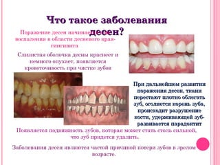 Что такое заболевания
                         десен?
  Поражение десен начинается с их
 воспаления в области десневого края-
             гингивита
 Слизистая оболочка десны краснеет и
     немного опухает, появляется
   кровоточивость при чистке зубов

                                         При дальнейшем развитии
                                           поражения десен, ткани
                                          перестают плотно облегать
                                          зуб, оголяется корень зуба,
                                           происходит разрушение
                                          кости, удерживающей зуб-
                                           развивается парадонтит
 Появляется подвижность зубов, которая может стать столь сильной,
                  что зуб придется удалить.
Заболевания десен являются частой причиной потери зубов в зрелом
                           возрасте.
 