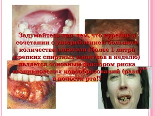 Задумайтесь над тем, что курение в
 сочетании с употреблением большого
  количества алкоголя (более 1 литра
крепких спиртных напитков в неделю)
  является основным фактором риска
возникновения новообразований (рака)
            в полости рта!!!
 