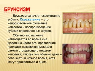 БРУКСИЗМ
    Бруксизм означает скрежетание
 зубами. Скрежетание – это
 непроизвольное сжимание
 челюстей и воспроизведение
 зубами определенных звуков.
    Обычно это явление
 наблюдается во время сна.
 Довольно часто его проявления
 проходят незамеченными для
 самого страдающего недугом
 человека, так как они обычно дают о
 себе знать в ночное время, хотя
 могут проявляться и днем.
 