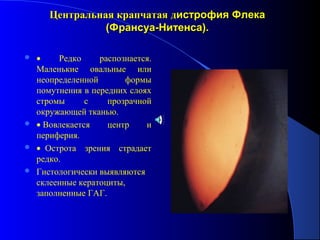Центральная крапчатая дистрофия Флека
               (Франсуа-Нитенса).

 •    Редко     распознается.
  Маленькие овальные или
  неопределенной       формы
  помутнения в передних слоях
  стромы      с    прозрачной
  окружающей тканью.
 • Вовлекается    центр    и
  периферия.
 • Острота зрения страдает
  редко.
 Гистологически выявляются
  склеенные кератоциты,
  заполненные ГАГ.
 