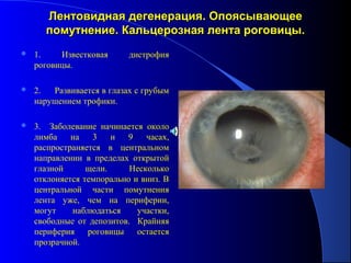 Лентовидная дегенерация. Опоясывающее
      помутнение. Кальцерозная лента роговицы.
   1.    Известковая      дистрофия
    роговицы.

   2.  Развивается в глазах с грубым
    нарушением трофики.

   3. Заболевание начинается около
    лимба    на   3    и  9    часах,
    распространяется в центральном
    направлении в пределах открытой
    глазной      щели.     Несколько
    отклоняется темпорально и вниз. В
    центральной части помутнения
    лента уже, чем на периферии,
    могут    наблюдаться     участки,
    свободные от депозитов. Крайняя
    периферия    роговицы    остается
    прозрачной.
 