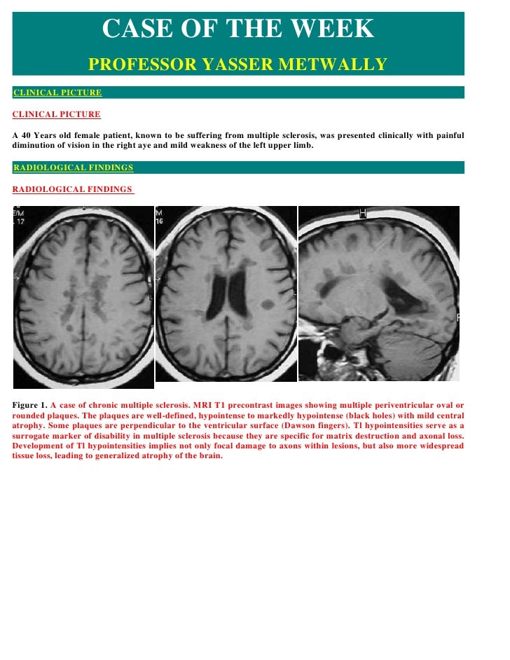 Case record... Multiple sclerosis