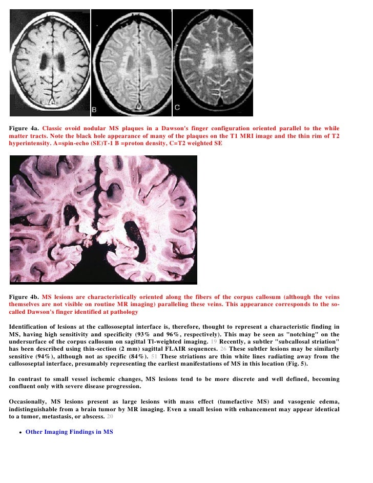 Case record... Multiple sclerosis