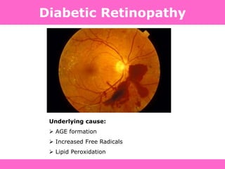 Underlying cause:
 AGE formation
 Increased Free Radicals
 Lipid Peroxidation
Diabetic Retinopathy
 