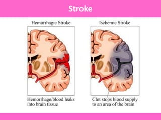 Stroke
 