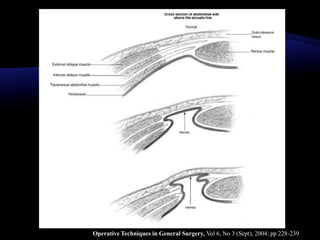Operative Techniques in General Surgery, Vol 6, No 3 (Sept), 2004: pp 228-239
 