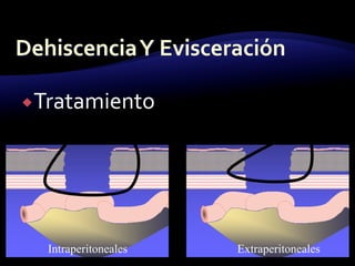 Tratamiento
Intraperitoneales Extraperitoneales
 