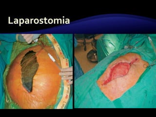 4. patologia pared abdominal