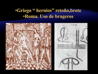 •Griego “ hernios” retoño,brote
•Roma. Uso de brageros
 