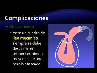  Atascamiento
 Ante un cuadro de
ileo mecánico
siempre se debe
descartar en
primer termino la
presencia de una
hernia atascada.
 