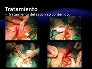  Tratamiento del saco y su contenido.
 