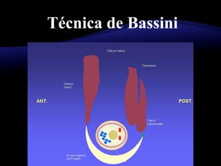 Técnica de Bassini
 