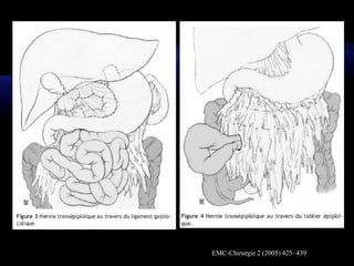 EMC-Chirurgie 2 (2005) 425–439
 
