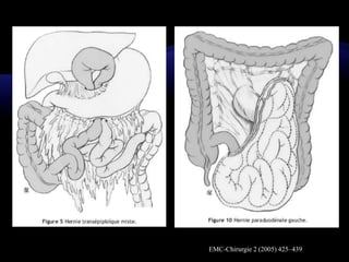 EMC-Chirurgie 2 (2005) 425–439
 