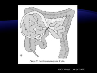 EMC-Chirurgie 2 (2005) 425–439
 