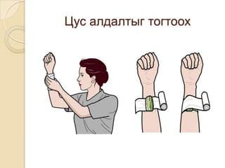 Цус алдалтыг тогтоох

 