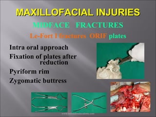 Mid face fractures / /certified fixed orthodontic courses by Indian ...
