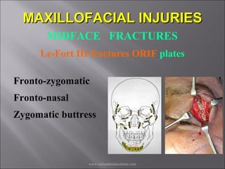 Mid face fractures / /certified fixed orthodontic courses by Indian ...