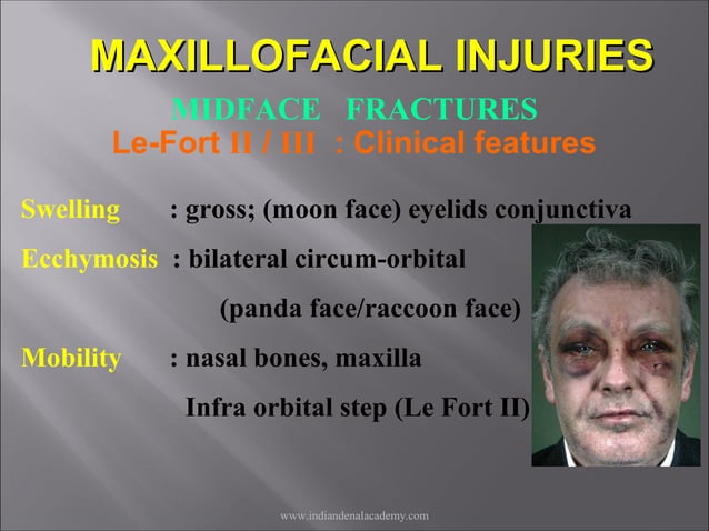 Mid face fractures / /certified fixed orthodontic courses by Indian ...