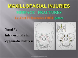 Mid face fractures / /certified fixed orthodontic courses by Indian ...