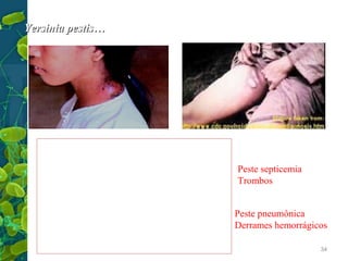 Yersinia pestis…

Peste bubônica
7 dias de incubação
Peste septicemia
Febre calafrios, mal estar geral, nauseas Trombos
conjuntivite, adenopatia regional…
BUBON
Frequente nas extremidades ou inguinal Peste pneumônica
Derrames hemorrágicos
Pode ocorrer celulite
Aparência tóxica
34

 