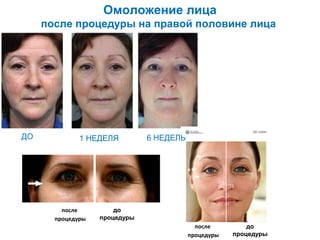 Омоложение лица
после процедуры на правой половине лица

ДО

1 НЕДЕЛЯ

после
процедуры

6 НЕДЕЛЬ

до
процедуры
после
процедуры

до
процедуры

 