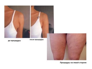 до процедуры

после процедуры

Процедуры на левой стороне

 