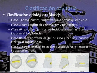 Clasificación cavitaria
• Clasificación etiológica (Black):
– Clase I: hoyos, puntos, surcos y fisuras de cualquier diente.
– Clase II: caras proximales de molares y premolares.
– Clase III: caras proximales de incisivos y caninos que no
incluyan el ángulo incisal.
– Clase IV: caras proximales de incisivos y caninos, cuando
afectan al ángulo incisal.
– Clase V: tercio gingival de las caras vestibulares o linguales
de cualquier diente.

 
