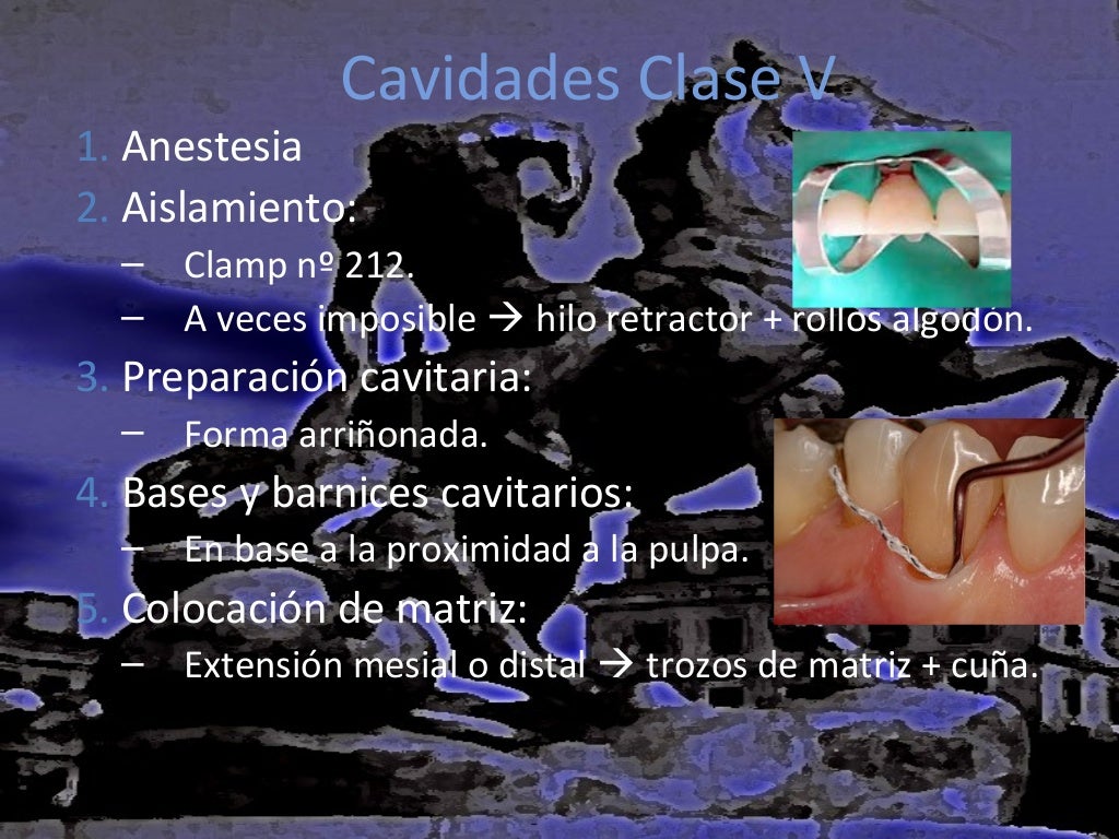 Guía clínica para obturaciones de amalgama y sus bases cavitarias