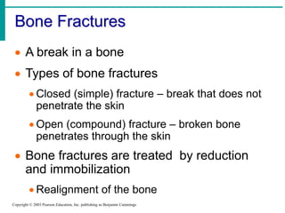 Bone Fractures
Copyright © 2003 Pearson Education, Inc. publishing as Benjamin Cummings
 A break in a bone
 Types of bone fractures
 Closed (simple) fracture – break that does not
penetrate the skin
 Open (compound) fracture – broken bone
penetrates through the skin
 Bone fractures are treated by reduction
and immobilization
 Realignment of the bone
 