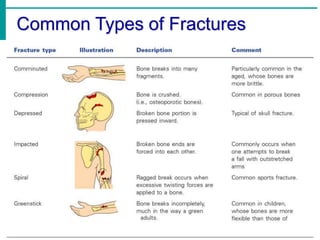 Common Types of Fractures
 