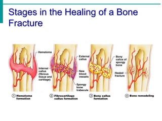 Stages in the Healing of a Bone
Fracture
 