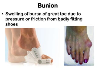 Bunion
• Swelling of bursa of great toe due to
pressure or friction from badly fitting
shoes
 